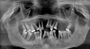 Fig 1. Presurgical panoramic radiograph of a patient with severe periodontal disease and who is an All-on-4–style treatment candidate.