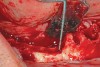 Fig 9. Alveolar bone reduction prior to dental implant placement in a mandibular All-on-4–style dental implant surgery.