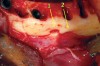 Fig 11. Accessory mental foramina (arrows) encountered during mandibular All-on-4–style dental implant surgery.