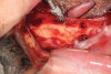 Fig 13. Mental foramen used to determine the posterior extent of tilted dental implant placement in a mandibular All-on-4–style dental implant surgery.