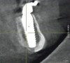 Fig 15. Cross-sectional CBCT scan slice from Figure 14 showing apical engagement of the dental implant with the dense cortical bone at the inferior border of the mandible.