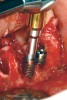 Fig 18. High-torque retrieval tool being used to remove dental implant during All-on-4–style treatment.