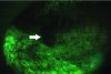 Fig 2. A repeat intraoral examination using illumination showed a loss of fluorescence, identified by the white arrow. Excisional biopsy and histologic examination gave a diagnosis of squamous papilloma. (photographs in Fig 1 and Fig 2 courtesy of Kevin D. Huff, DDS, Dover, Ohio)