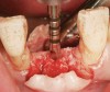 Figure 2  The 2-mm twist drill is employed to penetrate the cortical bone and go to depth in the trabecular bone.