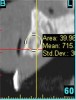 Figure 3  Radiograph with bone density recorded as 715 Hounsfield units; this correlates with D3 bone.