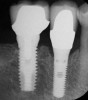 Figure 4  Supracrestal placement of a dental implant results in less bone loss than subcrestal placement because formation of the biologic width occurs supragingivally instead of subgingivally.