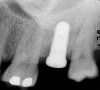 Figure 5  A tapered implant can compress bone in low-bone-density areas, thereby providing enhanced primary stability of the dental implant.