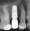 Figure 6  Platform switching denotes that the abutment is smaller than the implant platform. It facilitates less crestal bone loss by allowing formation of part of the biologic width on the abutment.