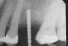 Figure 10 Initially, a 2-mm twist drill can be used to come within 1 mm of the subantral floor before using an osteotome to infracture the sinus floor.
