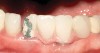 Figure 6  A fractured porcelain-fused-to-metal, implant-retained fixed partial denture. This prosthesis was cement-retained and difficult to remove from the underlying abutments.