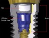 Figure 7  Illustration of an internal-connection implant with an internal length of 4 mm.