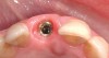 Figure 12  Occlusal view of the peri-implant soft-tissue contours around an implant replacing a maxillary right central incisor. The anatomic emergence profiles were developed by fabricating a custom provisional crown, cemented to an interim plastic abutment.