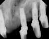 Figure 14  Radiograph of a custom-designed abutment on an implant in the area of a maxillary left central incisor. The implant was placed distally to the preplanned position. The custom abutment’s axial contours were modified for optimal emergence profiles and contours of the crown restoration.