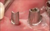 Figure 15a  These two posterior implants were placed optimally per the diagnostic wax patterns and surgical guide. They were restored with premachined titanium abutments.