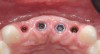 Figure 18  Occlusal view of four anterior maxillary implants with optimal peri-implant soft-tissue contours. Implant-level impressions of these implants were accomplished without incident.