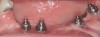 Figure 20b  Clinical image of the peri-implant mucosal tissues of the patient in Figure 20A. The tissues were nonkeratinized, mobile, and inflamed, and in places, sulcular depths exceeded 5 mm. Abutments were placed to raise the restorative platforms, which facilitated the definitive impression and fabrication of the definitive prosthesis.