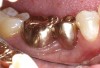 Figure 6  Cantilevered pontic replacing a mandibular second premolar where mesial drifting had created an edentulous space smaller than the normal tooth. The molar abutment had widely spaced roots with good periodontal support.