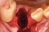 Figure 1  Occlusal view after extraction of tooth No. 27 using Piezosurgery<sup>®</sup> (Piezosurgery Inc, www.piezosurgery.com) and thin-bladed elevators.