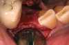 Figure 4  Occlusal view of the healed bony ridge, taken at the time of implant placement.