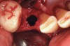 Figure 5  Occlusal view of the osteotomy site after retrieval of a core of regenerated material.