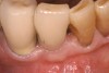 Figure 7  Occlusal view 18 months after the final restoration was inserted. Note the amount of preservation of hard and soft tissues.