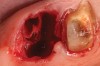 Figure 12  A patient who had tooth No. 2 extracted using Piezosurgery, periotomes, thin-bladed elevators, and small-beaked forceps, enabling preservation of all bony peaks.