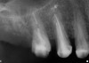 Figure 14  At the time of the 6-month reentry, the site appeared healed. Full ridge height preservation and graft resorption with bony replacement were confirmed radiographically.