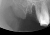 Figure 15  After extraction, the outline of the socket is  visualized radiographically.