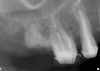 Figure 16  Radiograph showing the site after it was filled with the resorbable bone graft material and covered with the PTFE barrier.
