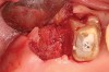 Figure 17  At the time of reentry, the pure-phase β-TCP particles appeared clinically to have resorbed, preserved the full ridge width, and been replaced by bone.