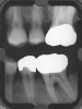 Figure 1a  Long-term results of a case involving a 55-year-old woman treated by regenerative periodontal surgery followed by periodontal maintenance every 3 months for 8 years. (A) Radiograph taken in May 2000