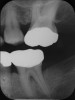 Figure 1b  Long-term results of a case involving a 55-year-old woman treated by regenerative periodontal surgery followed by periodontal maintenance every 3 months for 8 years. (B) radiograph of the same area taken in July 2008.</a></span><P>Figure 1b</P></div>    <div class=
