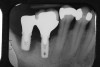 Figureb 2  (A) Clinical and (B) radiographic views of implants at site Nos. 30 and 31 demonstrating bone loss caused by peri-implantitis after 8 years in function. Note gingival inflammation and plaque accumulation around implants.