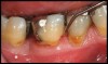 Figure 3b   patient in posttreatment periodontal maintenance program returned with (B) a 5-mm probing depth noted at a maintenance visit.