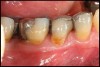 Figure 3d  The resolution of inflammation and bleeding on probing on the reevaluation appointment 6 weeks later.