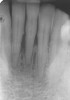 Figure 2  Preoperative radiograph shows healthy cuspids and advanced periodontal disease on the four mandibular incisors.