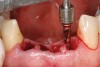 Figure 3a 3  Osteotomies prepared lingually.