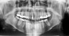 Figure 1a  Panoramic (A) and periapical radiographs (B, C) reveal the absence of periapical rarefaction in the area of the upper right central incisor. However, evidence of apical periodontitis can be seen clearly using the CBCT21 (D, E).