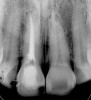 Figure 1b  Panoramic (A) and periapical radiographs (B, C) reveal the absence of periapical rarefaction in the area of the upper right central incisor. However, evidence of apical periodontitis can be seen clearly using the CBCT21 (D, E).