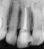 Figure 1c  Panoramic (A) and periapical radiographs (B, C) reveal the absence of periapical rarefaction in the area of the upper right central incisor. However, evidence of apical periodontitis can be seen clearly using the CBCT21 (D, E).