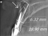 Figure 1d  Panoramic (A) and periapical radiographs (B, C) reveal the absence of periapical rarefaction in the area of the upper right central incisor. However, evidence of apical periodontitis can be seen clearly using the CBCT21 (D, E).