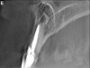 Figure 1e  Panoramic (A) and periapical radiographs (B, C) reveal the absence of periapical rarefaction in the area of the upper right central incisor. However, evidence of apical periodontitis can be seen clearly using the CBCT21 (D, E).