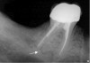 Figure 2a  Another case that clearly shows additional canal anatomy (distolingual root) not easily detected by periapical radiographs. Periapical radiograph depicting possible widened periodontal ligament (A). The CBCT clearly shows the missed canal in all three dimensions (B). The postoperative periapical radiograph shows the re-treatment, which includes the obturation of the distolingual canal24 (C).