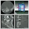 Figure 2b  Another case that clearly shows additional canal anatomy (distolingual root) not easily detected by periapical radiographs. Periapical radiograph depicting possible widened periodontal ligament (A). The CBCT clearly shows the missed canal in all three dimensions (B). The postoperative periapical radiograph shows the re-treatment, which includes the obturation of the distolingual canal24 (C).