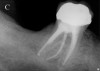 Figure 2c  Another case that clearly shows additional canal anatomy (distolingual root) not easily detected by periapical radiographs. Periapical radiograph depicting possible widened periodontal ligament (A). The CBCT clearly shows the missed canal in all three dimensions (B). The postoperative periapical radiograph shows the re-treatment, which includes the obturation of the distolingual canal24 (C).