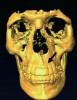 Figure 3a  The 3D capability of the CBCT shows the full extent of the horizontal fracture, as well as the fracture of the buccal and palatal plates.20