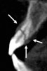 Figure 3c  The 3D capability of the CBCT shows the full extent of the horizontal fracture, as well as the fracture of the buccal and palatal plates.20