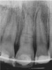 Figure 4a  Initially, the periapical radiographs showed the root fractures but not the extent of the lingual fracture or the alveolar complications (A,B).