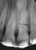 Figure 4b  Initially, the periapical radiographs showed the root fractures but not the extent of the lingual fracture or the alveolar complications (A,B).