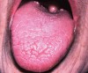 Figure 1  Tongue appears dry and fissured in a patient with salivary gland hypofunction.
